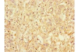 Immunohistochemistry of paraffin-embedded human pancreatic cancer using ABIN7158768 at dilution of 1:100