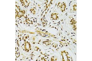 Immunohistochemistry of paraffin-embedded human breast cancer using ADAR antibody. (ADAR anticorps)