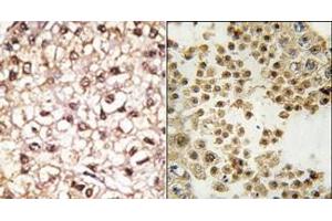(LEFT)Formalin-fixed and paraffin-embedded human cancer tissue reacted with the primary antibody, which was peroxidase-conjugated to the secondary antibody, followed by AEC staining. (Parkin anticorps  (N-Term))