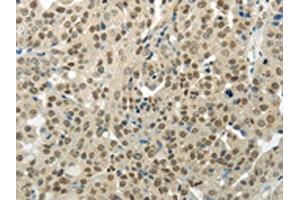 The image on the left is immunohistochemistry of paraffin-embedded Human breast cancer tissue using ABIN7189956(BAZ1B Antibody) at dilution 1/35, on the right is treated with synthetic peptide. (BAZ1B anticorps)