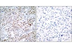 Immunohistochemistry analysis of paraffin-embedded human breast carcinoma tissue, using CREB (Ab-133) Antibody. (CREB1 anticorps  (AA 100-149))