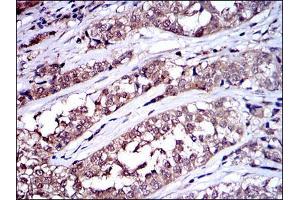 Immunohistochemical analysis of paraffin-embedded bladder cancer tissues using SRC mouse mAb with DAB staining.