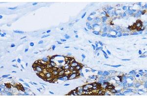 Immunohistochemistry of paraffin-embedded Human mammary cancer using EEA1 Polyclonal Antibody at dilution of 1:100 (40x lens).