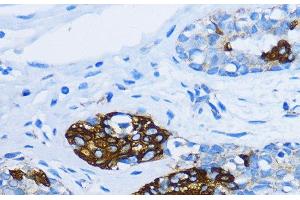 Immunohistochemistry of paraffin-embedded Human mammary cancer using EEA1 Polyclonal Antibody at dilution of 1:100 (40x lens). (EEA1 anticorps)