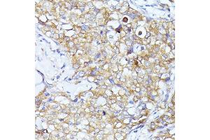 Immunohistochemistry of paraffin-embedded human mammary cancer using EIF3L antibody (ABIN6131772, ABIN6140074, ABIN6140075 and ABIN6225315) at dilution of 1:100 (40x lens). (EIF3L anticorps  (AA 1-230))