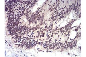 Immunohistochemical analysis of paraffin-embedded rectum cancer tissues using RAD50 mouse mAb with DAB staining.