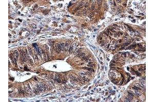 IHC-P Image Amphiregulin antibody detects Amphiregulin protein at cytoplasm in human colon cancer by immunohistochemical analysis. (Amphiregulin anticorps)
