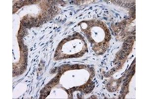 Immunohistochemical staining of paraffin-embedded Carcinoma of prostate tissue using anti-LIPG mouse monoclonal antibody. (LIPG anticorps)