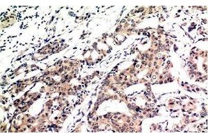 Immunohistochemistry of paraffin-embedded Human breast carcinoma tissue using Ubiquitin Monoclonal Antibody at dilution of 1:200.