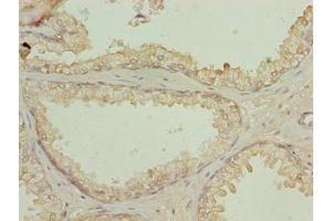 Immunohistochemistry of paraffin-embedded human prostate cancer using ABIN7161122 at dilution of 1:100 (N4BP2L2 anticorps  (AA 1-300))