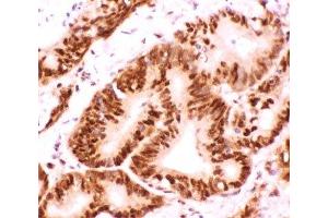 IHC-P: ATF2 antibody testing of human intestinal cancer tissue (ATF2 anticorps  (AA 93-450))