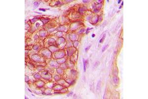 Immunohistochemical analysis of PKC mu (pY463) staining in human breast cancer formalin fixed paraffin embedded tissue section.