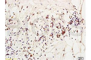 Formalin-fixed and paraffin embedded human breast carcinoma labeled with Anti-MCP-2 Polyclonal Antibody, Unconjugated (ABIN676283) at 1:200 followed by conjugation to the secondary antibody and DAB staining (CCL8 anticorps  (AA 24-99))