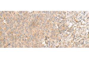 Immunohistochemistry of paraffin-embedded Human ovarian cancer tissue using RNF207 Polyclonal Antibody at dilution of 1:40(x200) (RNF207 anticorps)
