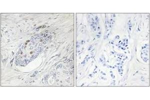 Immunohistochemistry analysis of paraffin-embedded human breast carcinoma, using ZNF232 Antibody. (ZNF232 anticorps  (AA 171-220))
