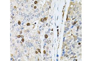 Immunohistochemistry of paraffin-embedded Human prostate cancer using PNKP Polyclonal Antibody at dilution of 1:100 (40x lens).