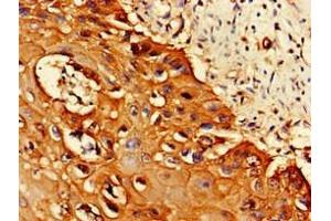 Immunohistochemistry of paraffin-embedded human cervical cancer using ABIN7164944 at dilution of 1:100