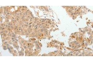 Immunohistochemistry of paraffin-embedded Human lung cancer tissue using ASCL1 Polyclonal Antibody at dilution 1:30 (ASCL1 anticorps)