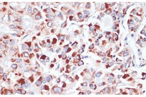 Immunohistochemistry of paraffin-embedded Human liver cancer using TFRC Polyclonal Antibody at dilution of 1:100 (40x lens). (Transferrin Receptor anticorps)