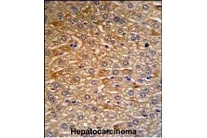 HRG Antibody (N-term) (R) IHC analysis in formalin fixed and paraffin embedded human hepatocarcinoma tissue followed by peroxidase conjugation of the secondary antibody and DAB staining. (HRG anticorps  (N-Term))