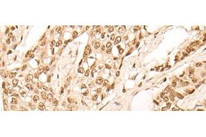 Immunohistochemistry of paraffin-embedded Human breast cancer tissue using EIF4A3 Polyclonal Antibody at dilution of 1:45(x200)