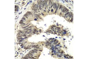 Immunohistochemistry of paraffin-embedded human colon carcinoma using NELFE antibody at dilution of 1:100 (x40 lens). (RDBP anticorps)