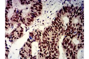 Immunohistochemical analysis of paraffin-embedded esophageal cancer tissues using BTRC mouse mAb with DAB staining.
