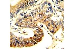 IHC analysis of FFPE human colon carcinoma stained with ASS1 antibody (ASS1 anticorps  (AA 192-221))