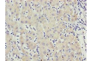 Immunohistochemistry of paraffin-embedded human liver cancer using ABIN7159626 at dilution of 1:100