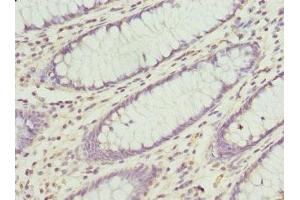 Immunohistochemistry of paraffin-embedded human colon cancer using ABIN7148782 at dilution of 1:100 (CXXC4 anticorps  (AA 1-198))