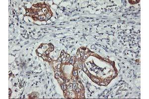 Immunohistochemical staining of paraffin-embedded Carcinoma of Human pancreas tissue using anti-PDSS2 mouse monoclonal antibody. (PDSS2 anticorps)