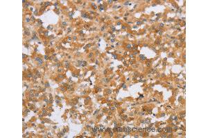 Immunohistochemistry of Human thyroid cancer using CRELD2 Polyclonal Antibody at dilution of 1:40 (CRELD2 anticorps)