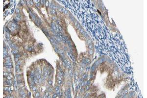 ABIN6279198 at 1/100 staining Human cervical cancer tissue by IHC-P. (BRI3 anticorps  (N-Term))