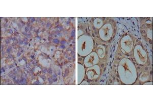 Immunohistochemical analysis of paraffin-embedded human breast carcinoma (left) and kidney carcinoma (right), showing cytoplasmic localization using GAPDH mouse mAb with DAB staining.