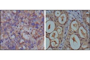 Immunohistochemical analysis of paraffin-embedded human breast carcinoma (left) and kidney carcinoma (right), showing cytoplasmic localization using GAPDH mouse mAb with DAB staining. (GAPDH anticorps)