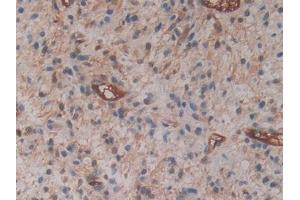 Detection of CYTH1 in Human Glioma Tissue using Polyclonal Antibody to Cytohesin 1 (CYTH1)
