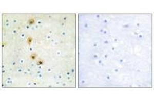 Immunohistochemistry analysis of paraffin-embedded human breast carcinoma tissue using Akt (Ab-326) antibody.