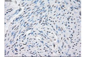 Immunohistochemical staining of paraffin-embedded Carcinoma of thyroid tissue using anti-STAT1 mouse monoclonal antibody. (STAT1 anticorps)