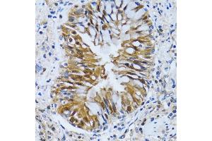 Immunohistochemistry of paraffin-embedded human lung cancer using IMPA1 antibody (ABIN2563424) at dilution of 1:100 (40x lens). (IMPA1 anticorps)