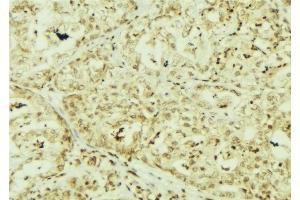 ABIN6267153 at 1/100 staining Human breast cancer tissue by IHC-P. (TCP1 alpha/CCTA anticorps  (pSer160, pSer162))
