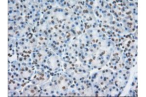 Immunohistochemical staining of paraffin-embedded Adenocarcinoma of Human colon tissue using anti-TACC3 mouse monoclonal antibody. (TACC3 anticorps)