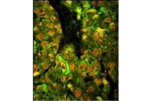 Immunofluorescence analysis of CD38 Antibody (C-term) with paraffin-embedded human hepatocarcinoma tissue. (CD38 anticorps  (C-Term))