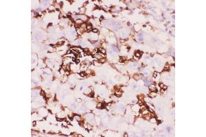 Anti-CD18 Picoband antibody, IHC(P) IHC(P): Human Lung Cancer Tissue