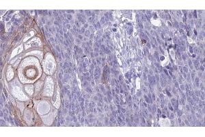 ABIN6272629 at 1/100 staining Human Head and neck cancer tissue by IHC-P. (KLRC2/4 anticorps)