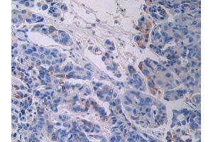 IHC-P analysis of Human Breast Cancer Tissue, with DAB staining. (FGFR3 anticorps  (AA 166-375))