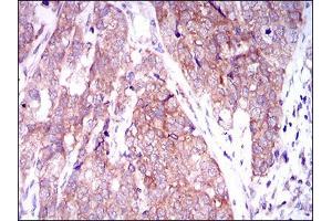 Immunohistochemical analysis of paraffin-embedded bladder cancer tissues using MARK3 mouse mAb with DAB staining. (MARK3 anticorps  (AA 435-658))