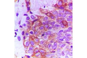 Immunohistochemical analysis of FGFR2 staining in human breast cancer formalin fixed paraffin embedded tissue section. (FGFR2 anticorps  (Center))