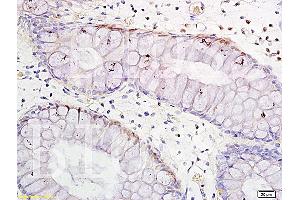 Formalin-fixed and paraffin embedded human colitis tissue labeled with Anti-TNF-alpha Polyclonal Antibody, Unconjugated (ABIN724565) 1:300 followed by conjugation to the secondary antibody and DAB staining (TNF alpha anticorps  (AA 86-150))