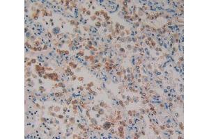 IHC-P analysis of lung cancer tissue, with DAB staining. (Paxillin anticorps  (AA 201-461))