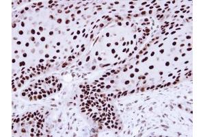 IHC-P Image Immunohistochemical analysis of paraffin-embedded Cal27 Xenograft, using hnRNP C1/C2 , antibody at 1:100 dilution.